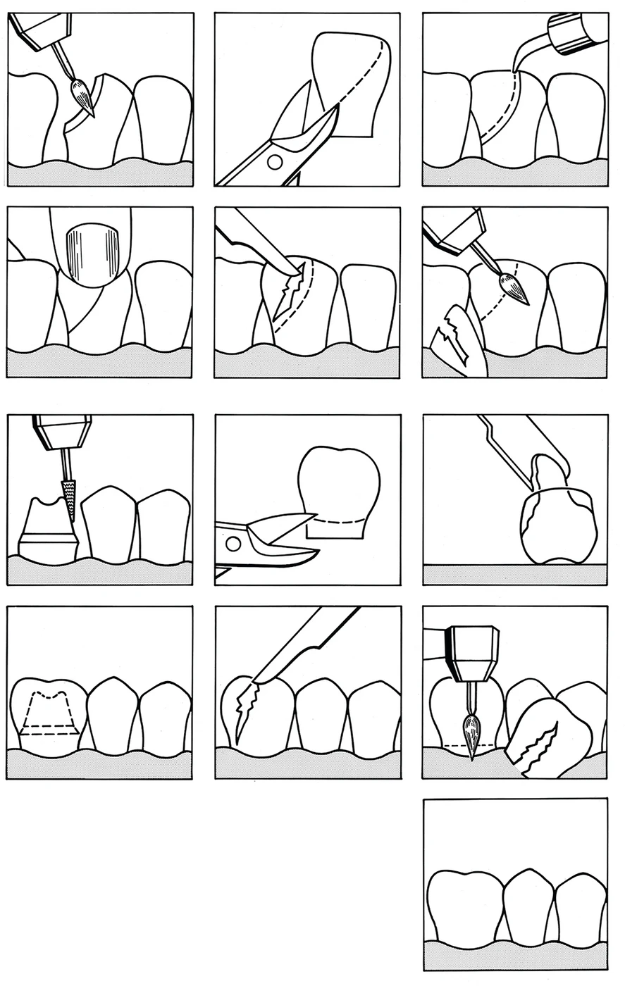 Strip-Kronen Color Packung 5 Stück Nr. 132