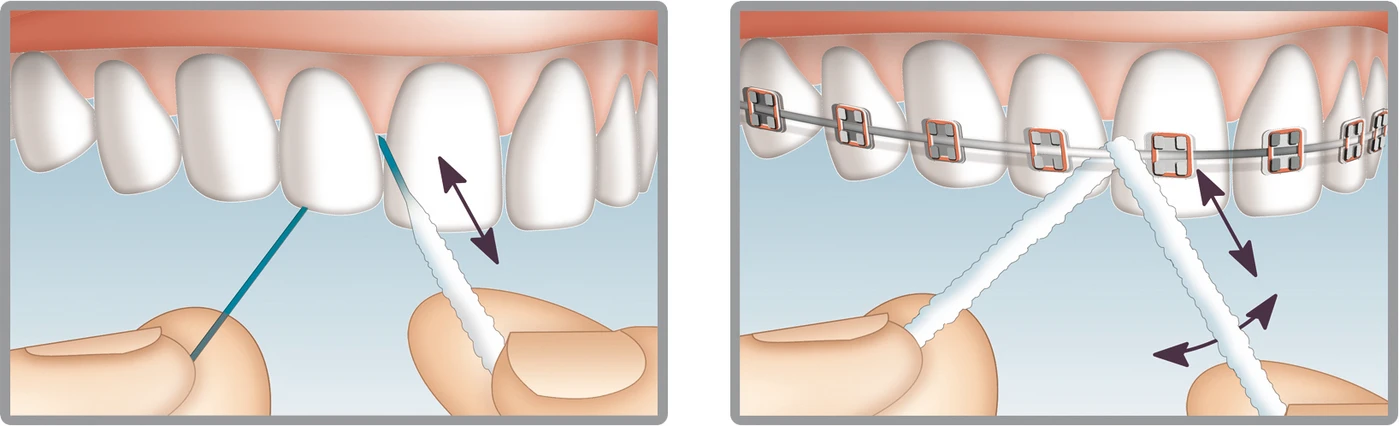 Mirafloss® Implant Rolle 20 Stück medium, Ø 2,2 mm, 15 cm Mirafloss® Implant Rolle 20 Stück medium, Ø 2,2 mm, 15 cm