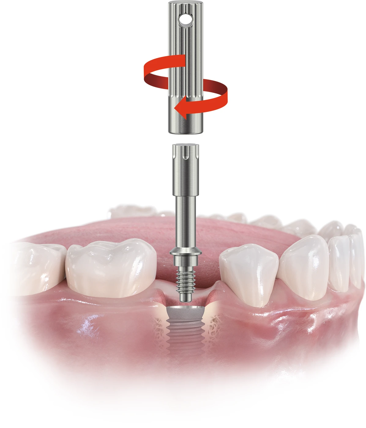 MulTipeg®-Eindreher Stück