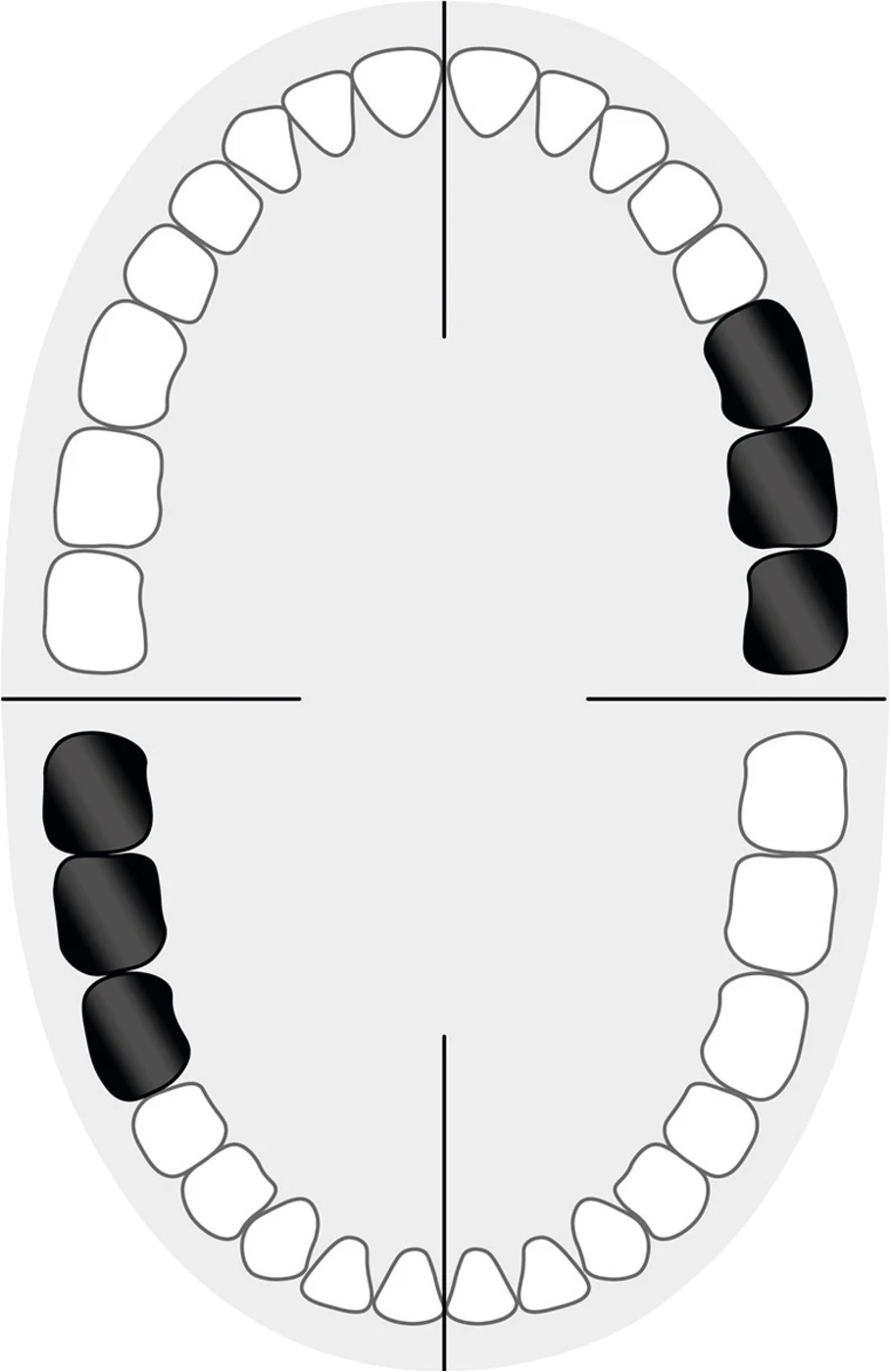 KKD® Klammern Standard Stück Nr. 13A, für Molaren im 1. und 3. Quadranten
