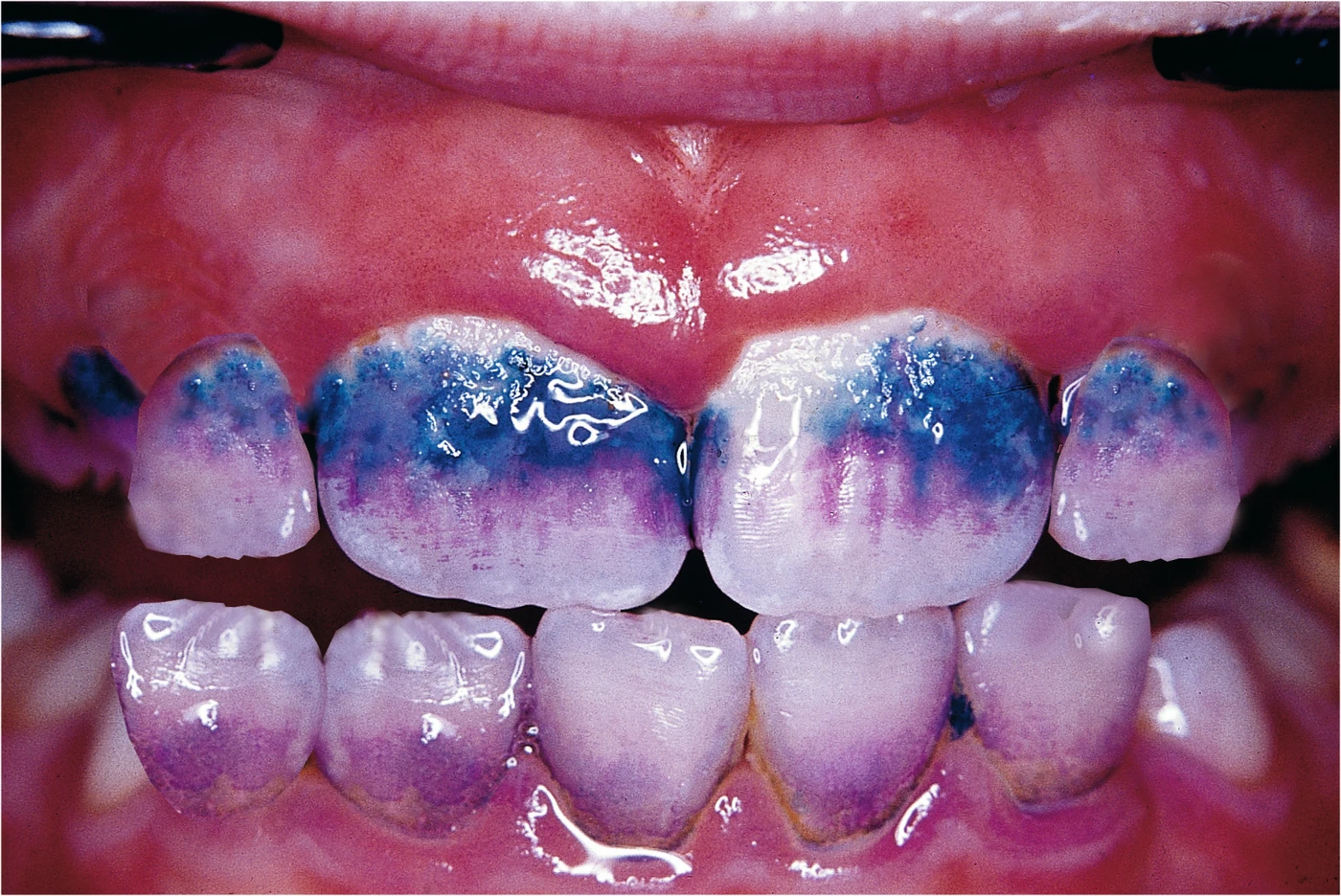 MIRA-2-TON® TABLETS Packung 5 x 10 Stück